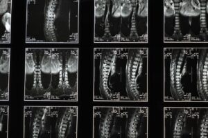 workers comp settlement for disc injury